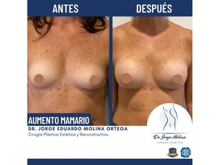 Aumento de busto - Dr. Jorge Molina