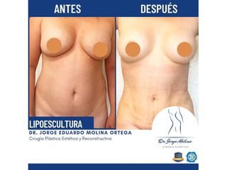 Lipoescultura - Dr. Jorge Molina