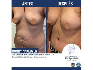 Mommy makeover - Dr. Jorge Molina