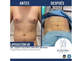 Liposucción HD - Dr. Jorge Molina