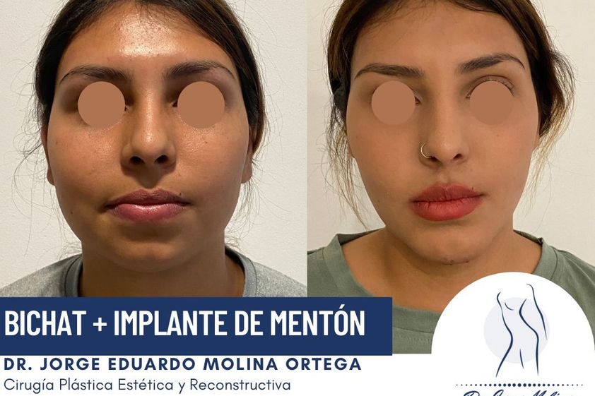 Bolsas de Bichat antes y después - 788252