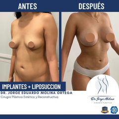 Liposucción - Dr. Jorge Molina