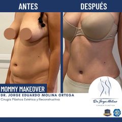 Mommy makeover - Dr. Jorge Molina
