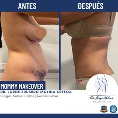 Mommy makeover - Dr. Jorge Molina