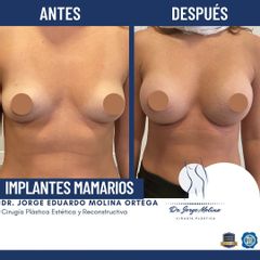 Aumento de busto - Dr. Jorge Molina