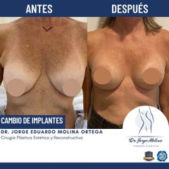 Mastopexia - Dr. Jorge Molina