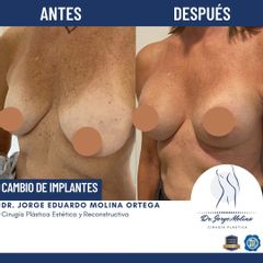 Mastopexia - Dr. Jorge Molina