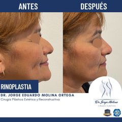 Rinoplastia - Dr. Jorge Molina