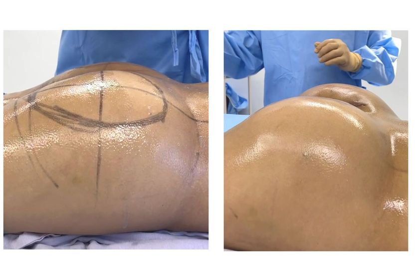 Gluteoplastia antes y después - 800582