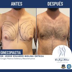 Cirugía ginecomastia - Dr. Jorge Molina