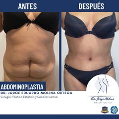 Abdominoplastia - Dr. Jorge Molina