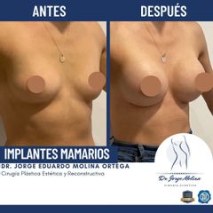 Aumento de busto - Dr. Jorge Molina
