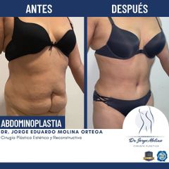 Abdominoplastia - Dr. Jorge Molina