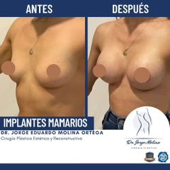 Aumento de busto - Dr. Jorge Molina