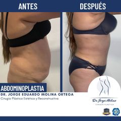Abdominoplastia - Dr. Jorge Molina