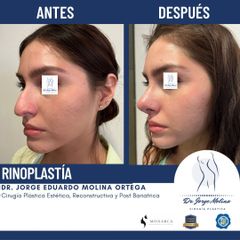 Rinoplastia - Dr. Jorge Molina