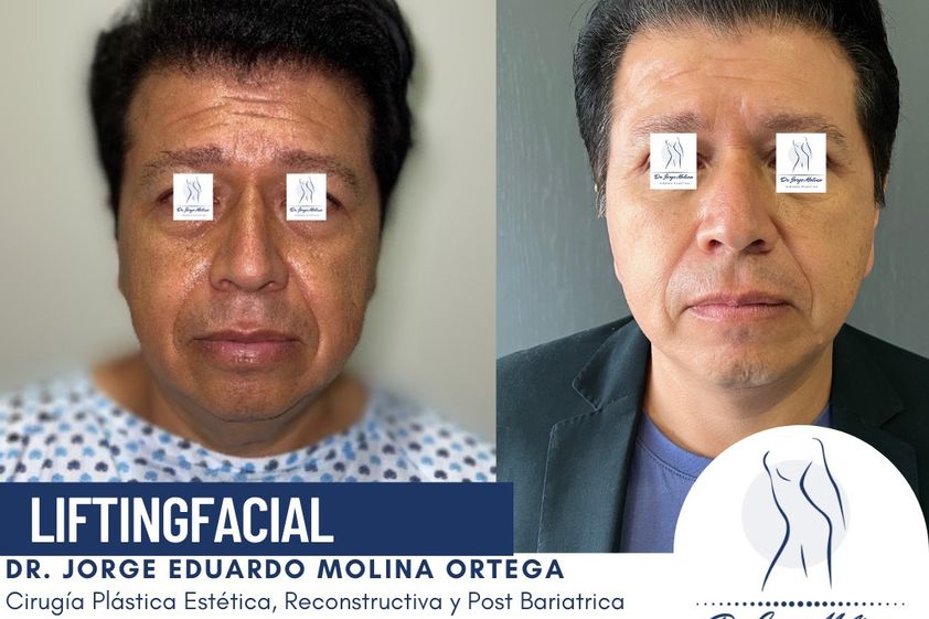 Lifting antes y después - 831001