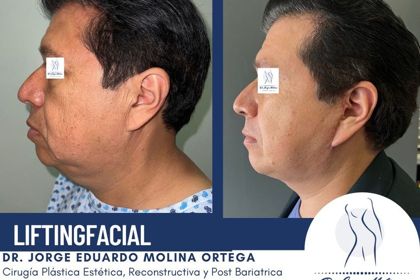 Lifting antes y después - 831003