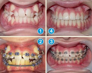 Ortodoncia - Clínica Dental Condesa