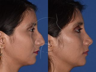 Antes y después de Rinoplastia para la Eliminación de giba (Joroba) - Perfil Derecho