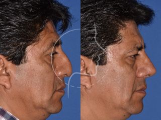 Antes y después de Rinoplastia en Varones - Perfil Derecho