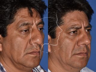 Antes y después de Rinoplastia en Varones - 3/4 Derecho