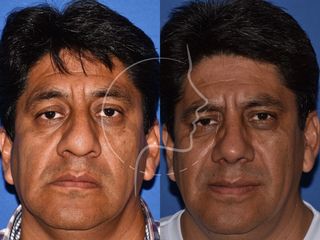 Antes y después de Rinoplastia en Varones - Frontal