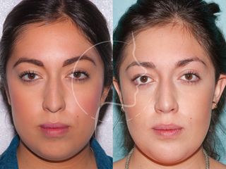 Antes y después de Mentoplastia + Bichectomia: Frontal