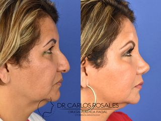 Antes y después de Rinoplastia