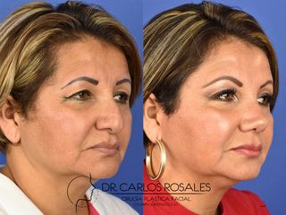 Antes y después de Rinoplastia