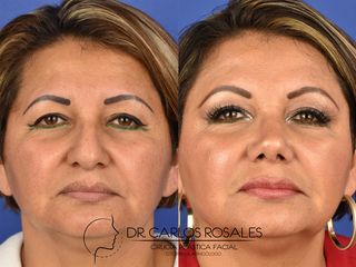 Antes y después de Rinoplastia