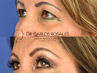 Antes y después de Levantamnento de Cejas 