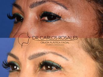 Blefaroplastia - 641787