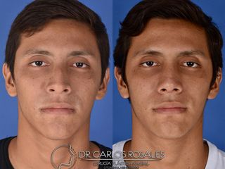 Antes y después de Rinoplastia