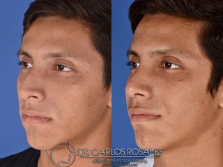 Antes y después de Rinoplastia