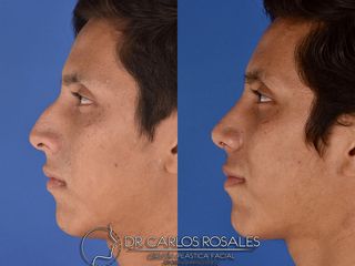 Antes y después de Rinoplastia