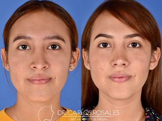 Antes y después de Rinoplastia