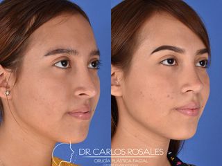 Antes y después de Rinoplastia