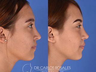 Antes y después de Rinoplastia