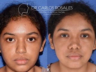 Antes y después de Rinoplastia