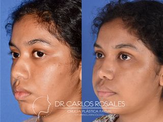 Antes y después de Rinoplastia