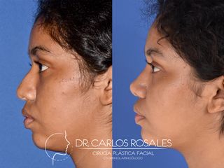 Antes y después de Rinoplastia