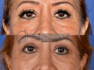 Antes y después de Blefaroplastia