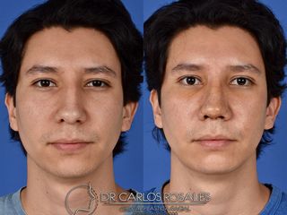 Antes y después de Rinoplastia