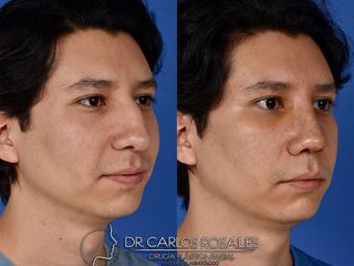 Antes y después de Rinoplastia