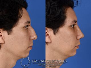 Antes y después de Rinoplastia