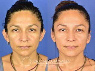 Antes y después de Otoplastia - frente