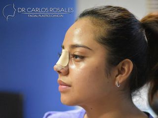 Recuperación de Rinoplastia