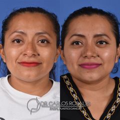 Antes y después de Rinoplastia