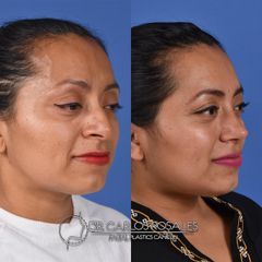 Antes y después de Rinoplastia